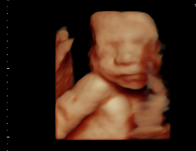 3D ultrasound image at 25 weeks